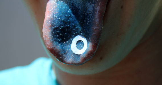 Student with tongue died blue and a paper disc helping show the papillae