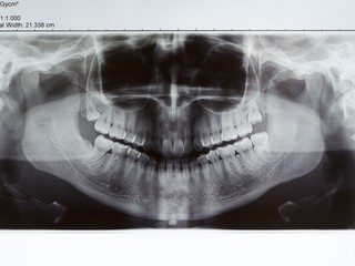 X-ray of teeth