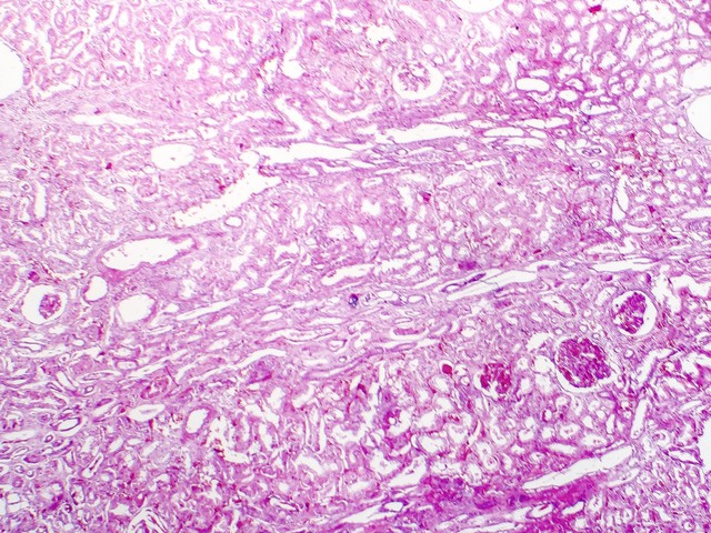 kideny cells indicating kidney failure