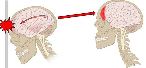 Drawing of a human head impacting a wall and damaging the front region of the brain