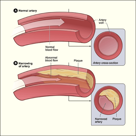 Drawing shows the cross-sections of a clear artery on top and a plaque filled artery on the bottom