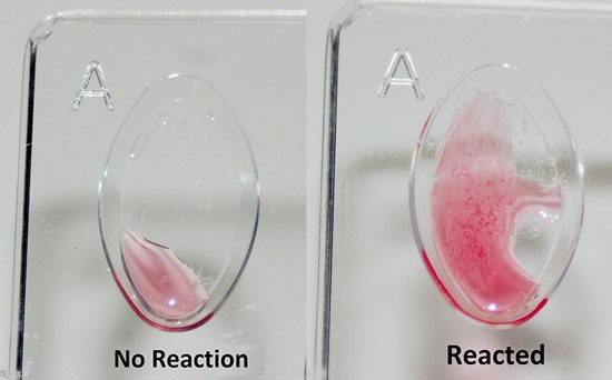Two blood samples exposed to antiserum. In the sample on the right, reactions produce visible particles in solution.