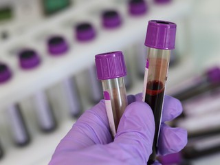 laboratory vials with blood samples