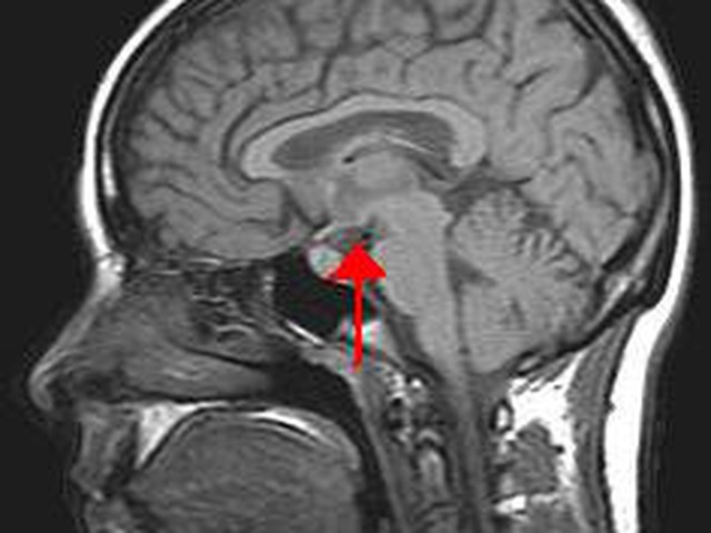 A brain scan shows a hypothalamus highlighted in red