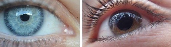 Two images of eyes with a smaller pupil on the left and a larger pupil on the right