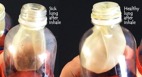 A picture of the model of a sick lung that inflates only a little, and the model of a healthy lung that inflates fully.