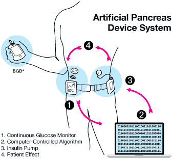 FDA illustration of an artificial pancreas