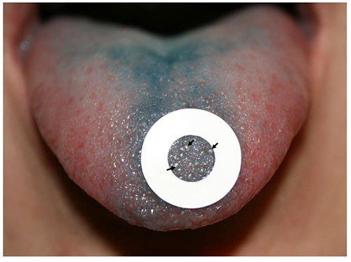 A white ring is placed on a blue-stained tongue while papillae in the rings are counted