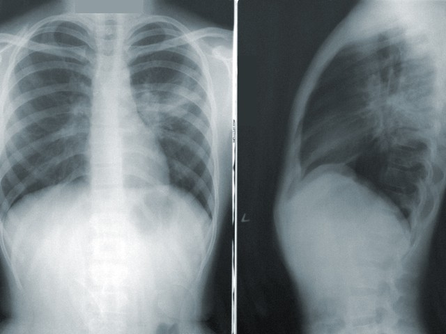 Chest x-ray