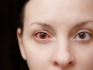 Eye infection