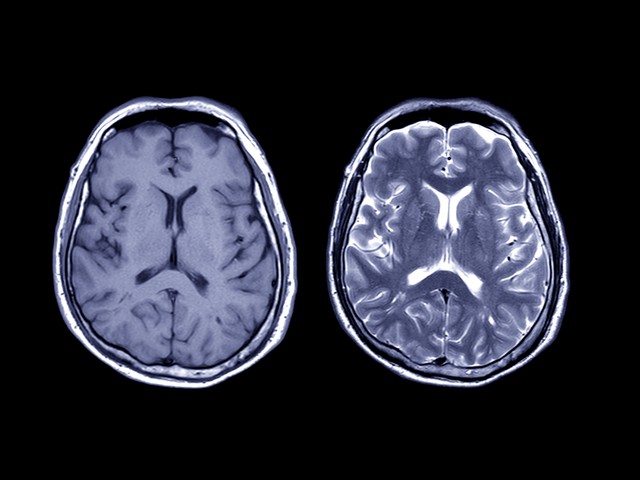 MRI on brain