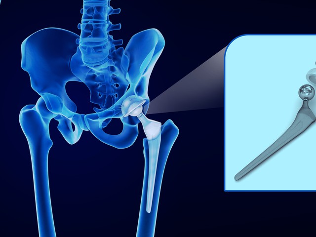 hip replacement joint