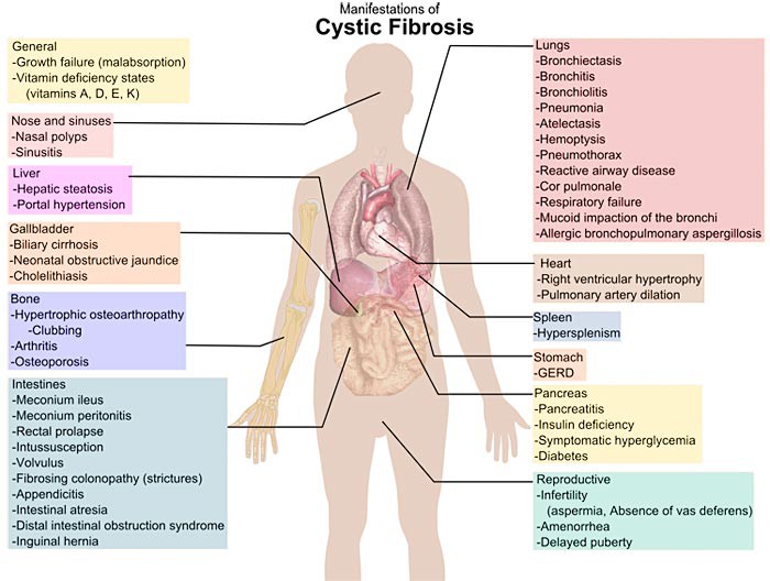 Diagram of the human body and systems that can be affected by cystic fibrosis