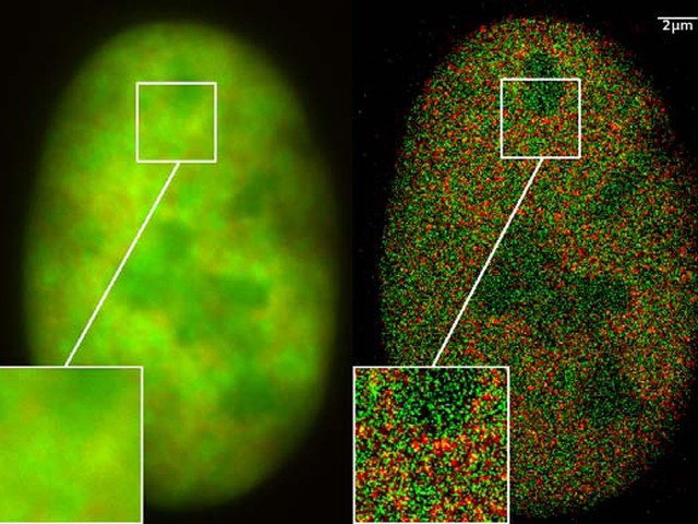 bone cancer cell