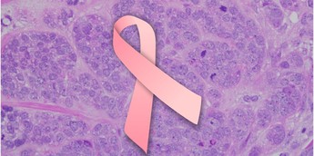 AI project / Image of pink breast cancer ribbon in front of a background of high-grade invasive ductal carcinoma cells