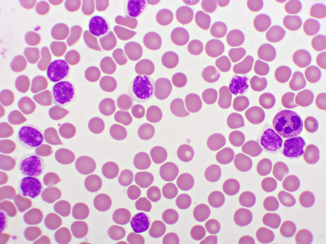 blood smear with leukemia