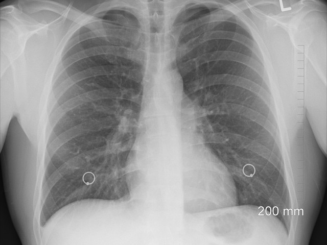 x-ray of lungs chest ribs