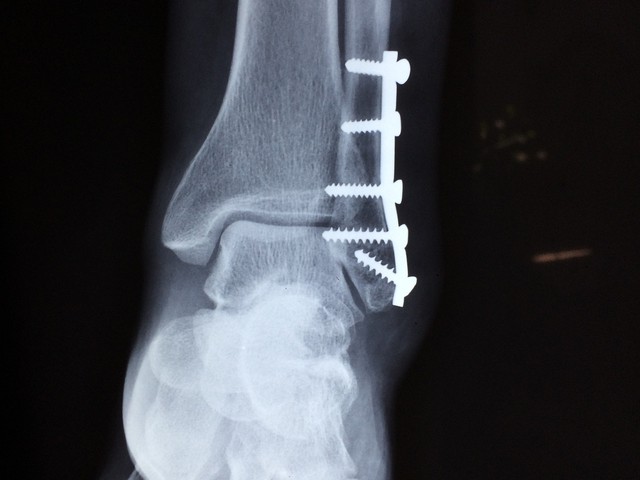 x-ray broken ankle